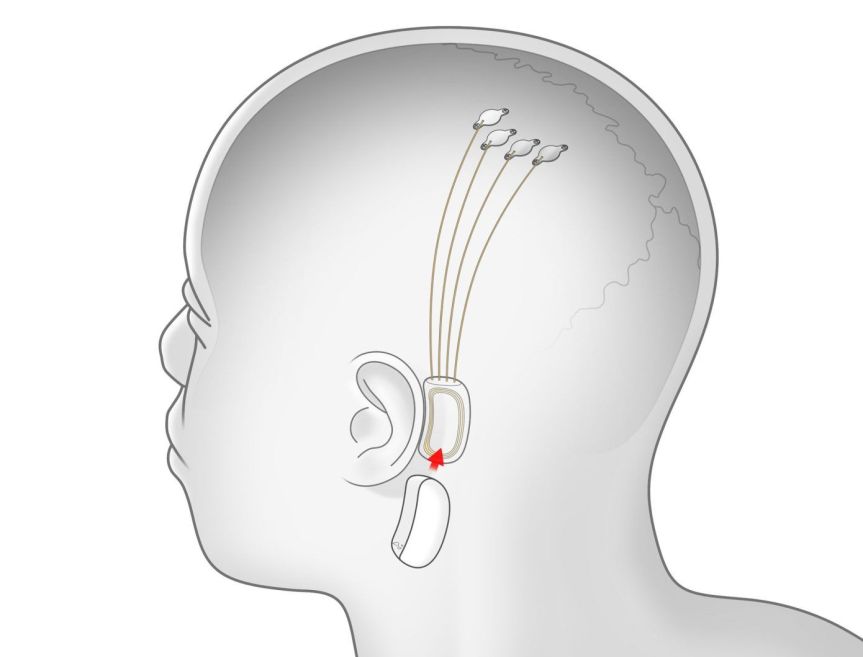 neuralink-brain-chip-implant